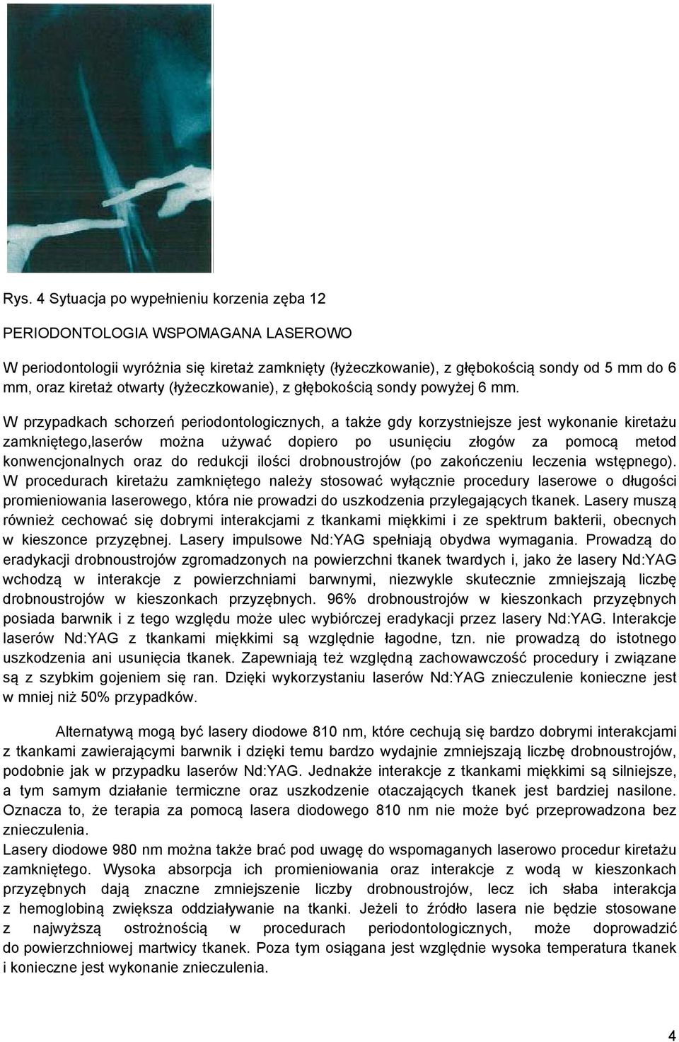 W przypadkach schorzeń periodontologicznych, a także gdy korzystniejsze jest wykonanie kiretażu zamkniętego,laserów można używać dopiero po usunięciu złogów za pomocą metod konwencjonalnych oraz do