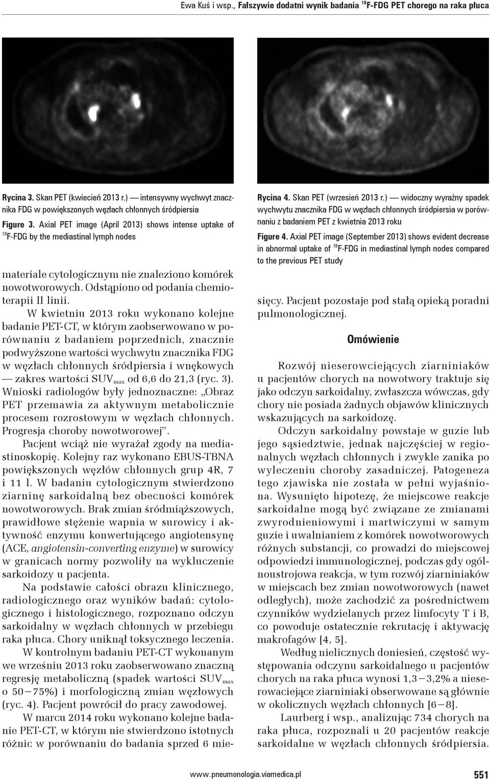 Skan PET (wrzesień 2013 r.) widoczny wyraźny spadek wychwytu znacznika FDG w węzłach chłonnych śródpiersia w porównaniu z badaniem PET z kwietnia 2013 roku Figure 4.