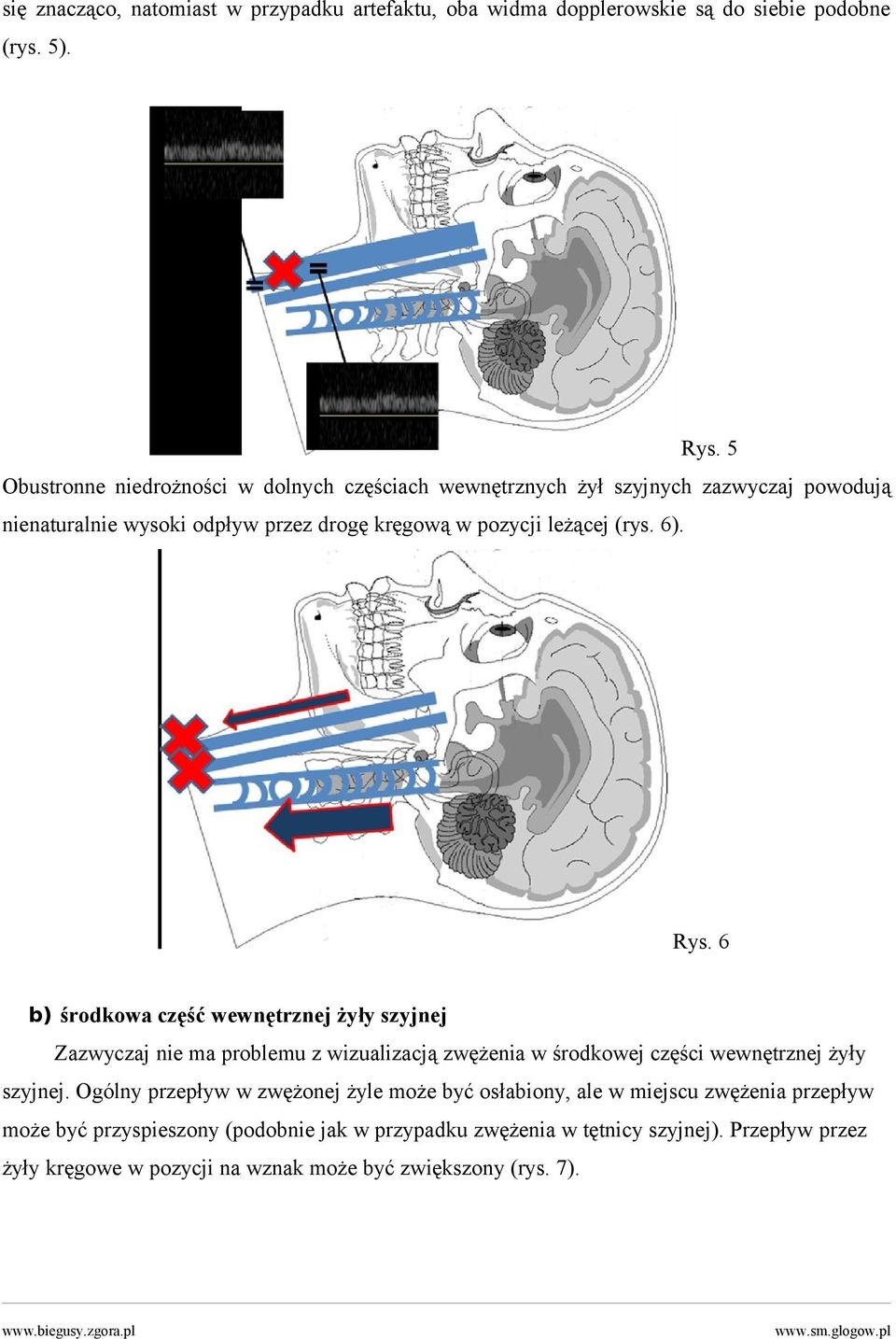 6). Rys. 6 b) środkowa część wewnętrznej żyły szyjnej Zazwyczaj nie ma problemu z wizualizacją zwężenia w środkowej części wewnętrznej żyły szyjnej.