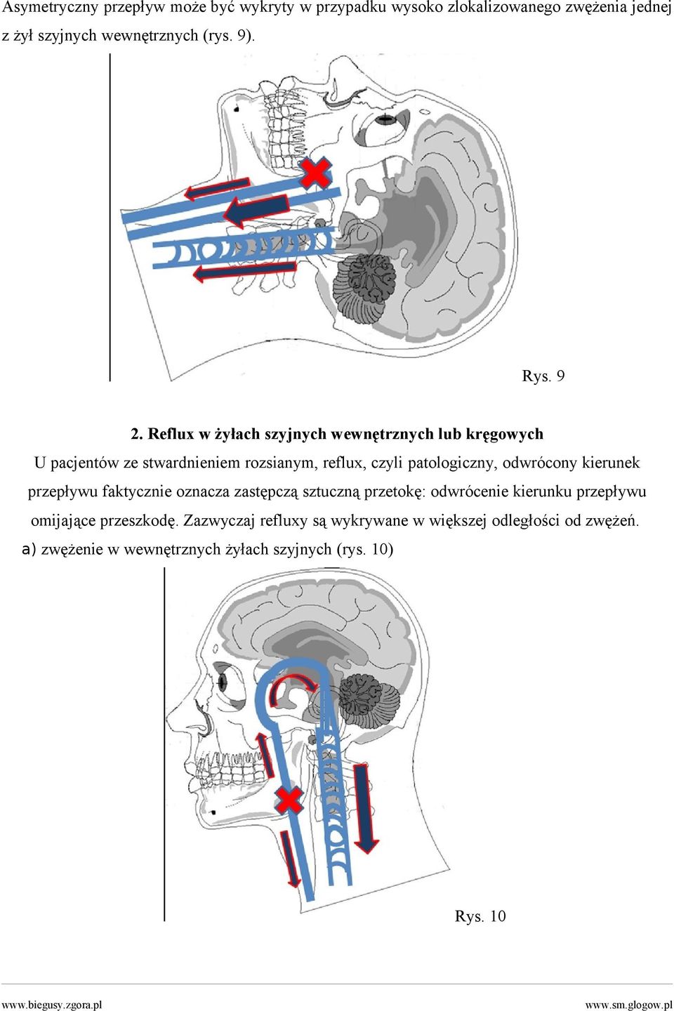 Reflux w żyłach szyjnych wewnętrznych lub kręgowych U pacjentów ze stwardnieniem rozsianym, reflux, czyli patologiczny,