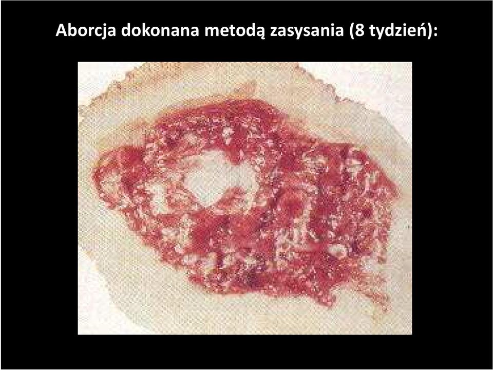metodą