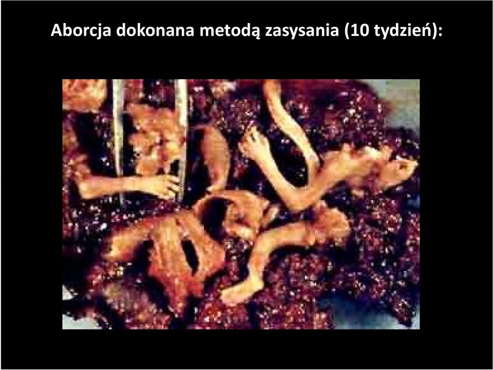 metodą