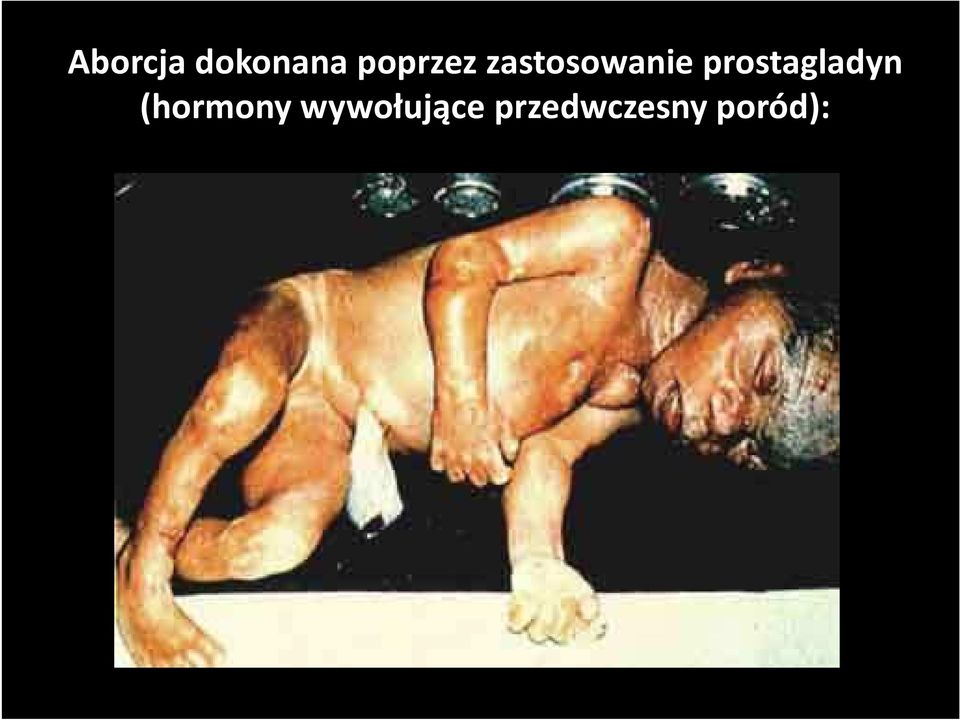prostagladyn (hormony
