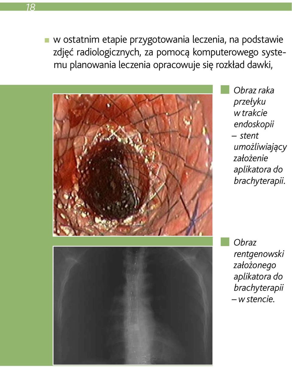 Obraz raka przełyku w trakcie endoskopii stent umoz liwiający załoz enie aplikatora