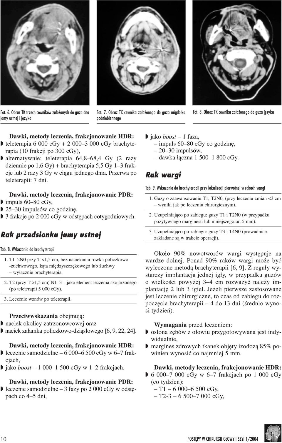 68,4 Gy (2 razy dziennie po 1,6 Gy) + brachyterapia 5,5 Gy 1 3 frakcje lub 2 razy 3 Gy w ci¹gu jednego dnia. Przerwa po teleterapii: 7 dni.