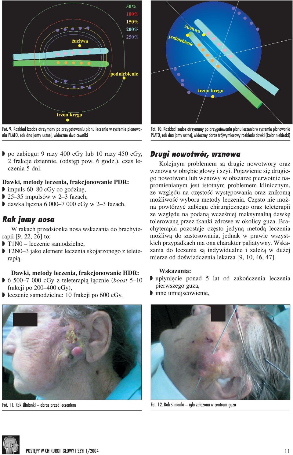 Rozk³ad izodoz otrzymany po przygotowaniu planu leczenia w systemie planowania PLATO, rak dna jamy ustnej, widoczny obraz trójwymiarowy rozk³adu dawki (kolor niebieski) po zabiegu: 9 razy 400 cgy lub