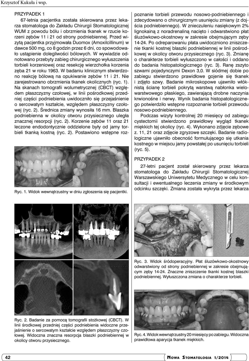podniebiennej. Przed wizytą pacjentka przyjmowała Duomox (Amoxilcillinum) w dawce 500 mg, co 8 godzin przez 6 dni, co spowodowało ustąpienie dolegliwości bólowych.