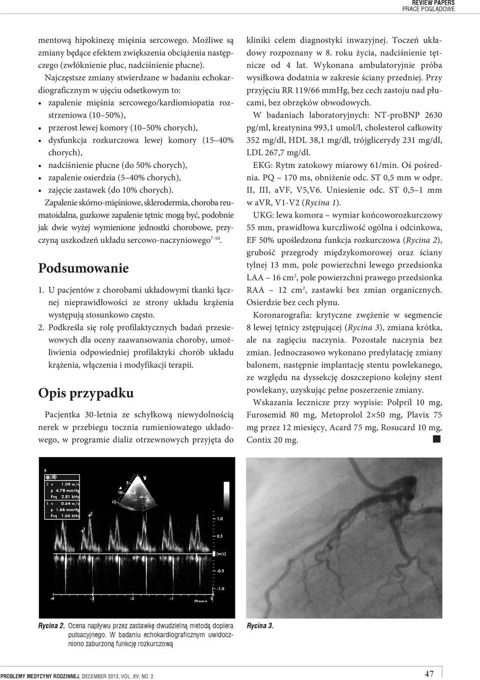 dysfunkcja rozkurczowa lewej komory (15 40% chorych), nadciśnienie płucne (do 50% chorych), zapalenie osierdzia (5 40% chorych), zajęcie zastawek (do 10% chorych).