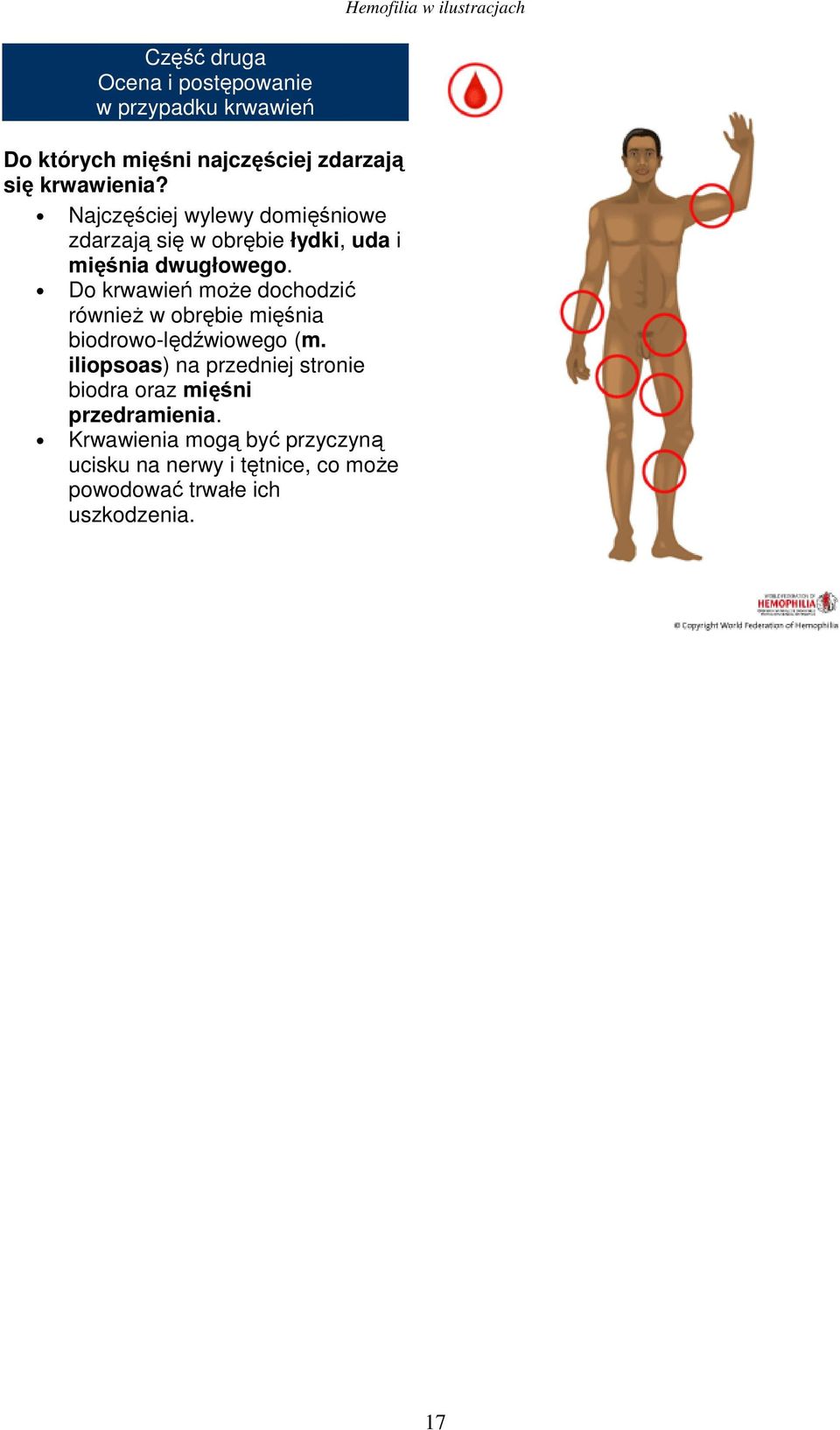 Do krwawień może dochodzić również w obrębie mięśnia biodrowo-lędźwiowego (m.