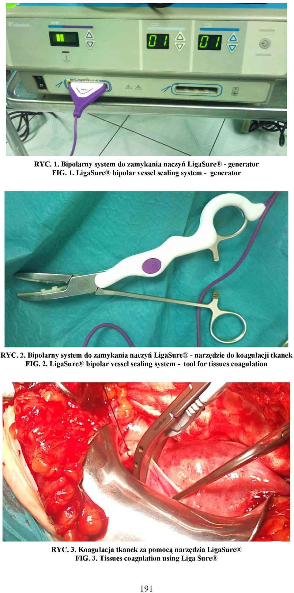 LigaSure bipolar vessel sealing system - tool for tissues coagulation RYC. 3.