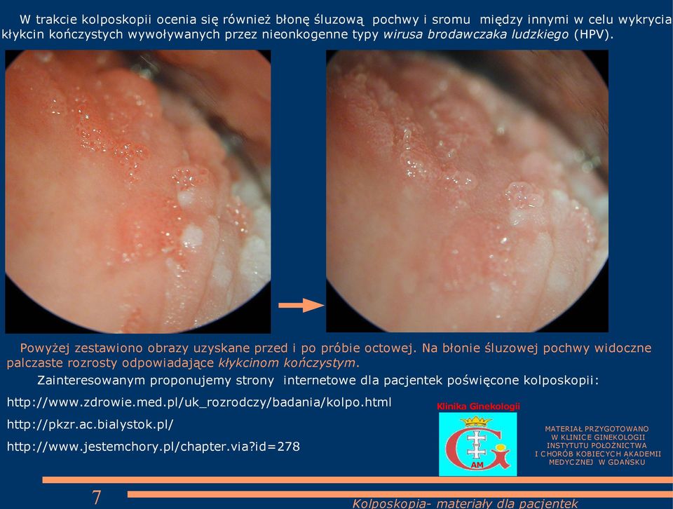 Zainteresowanym proponujemy strony internetowe dla pacjentek poświęcone kolposkopii: http://www.zdrowie.med.pl/uk_rozrodczy/badania/kolpo.html http://pkzr.ac.bialystok.