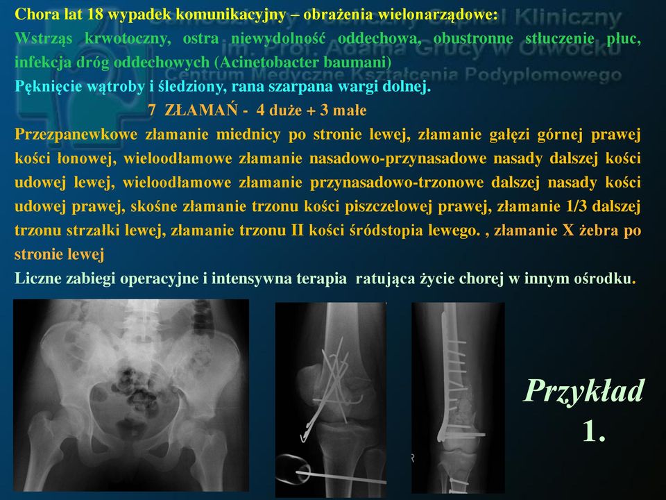 7 ZŁAMAŃ - 4 duże + 3 małe Przezpanewkowe złamanie miednicy po stronie lewej, złamanie gałęzi górnej prawej kości łonowej, wieloodłamowe złamanie nasadowo-przynasadowe nasady dalszej kości udowej