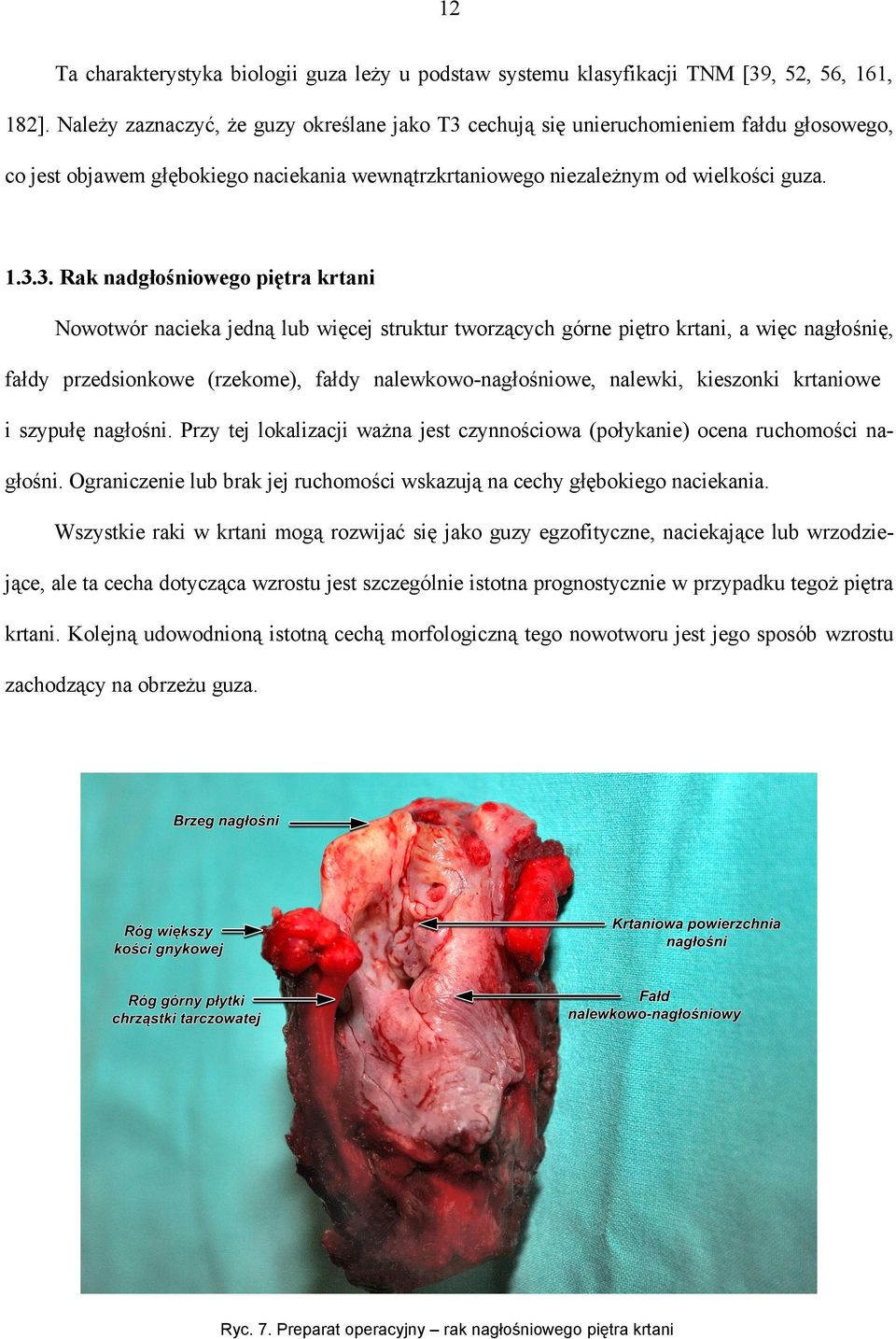 cechują się unieruchomieniem fałdu głosowego, co jest objawem głębokiego naciekania wewnątrzkrtaniowego niezależnym od wielkości guza. 1.3.