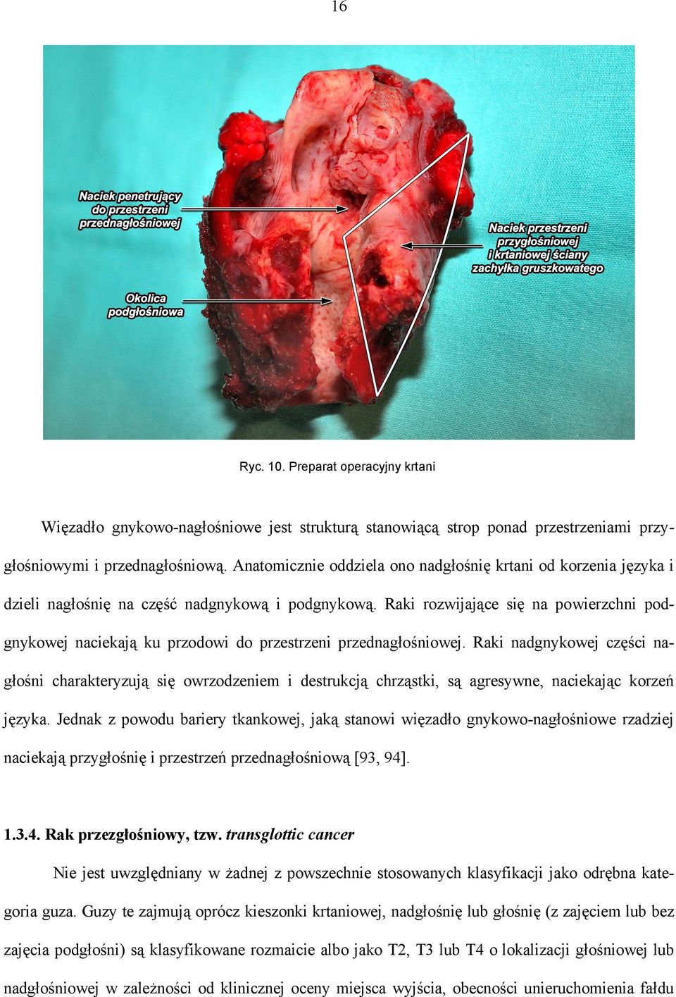 Raki rozwijające się na powierzchni podgnykowej naciekają ku przodowi do przestrzeni przednagłośniowej.