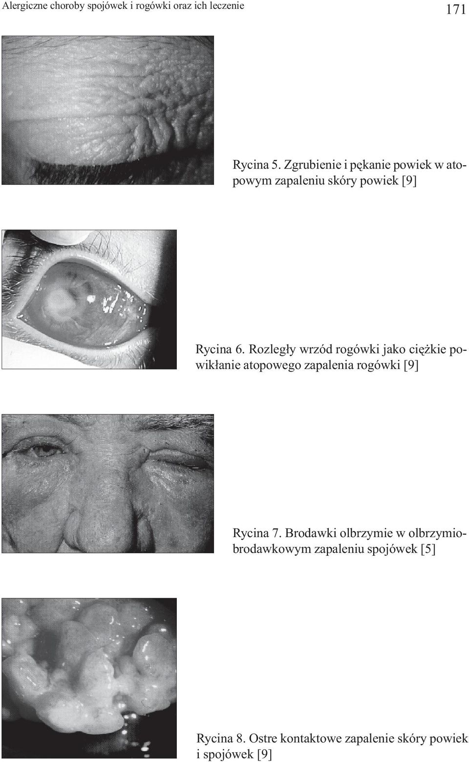 Rozleg³y wrzód rogówki jako ciê kie powik³anie atopowego zapalenia rogówki [9] Rycina 7.