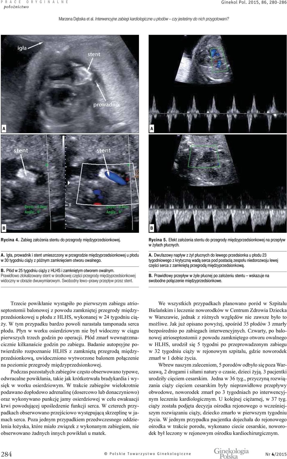 Prawidłowo zlokalizowany stent w środkowej części przegrody międzyprzedsionkowej widoczny w obrazie dwuwymiarowym. Swobodny lewo prawy przepływ przez stent. Rycina 5.