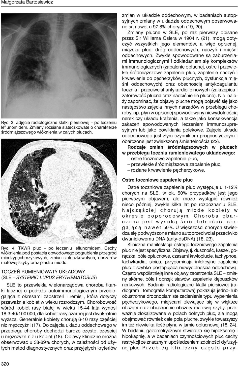 Toczeń rumieniowaty układowy (SLE systemic lupus erythematosus) SLE to przewlekła wielonarządowa choroba tkanki łącznej o podłożu autoimmunologicznym przebiegająca z okresami zaostrzeń i remisji,