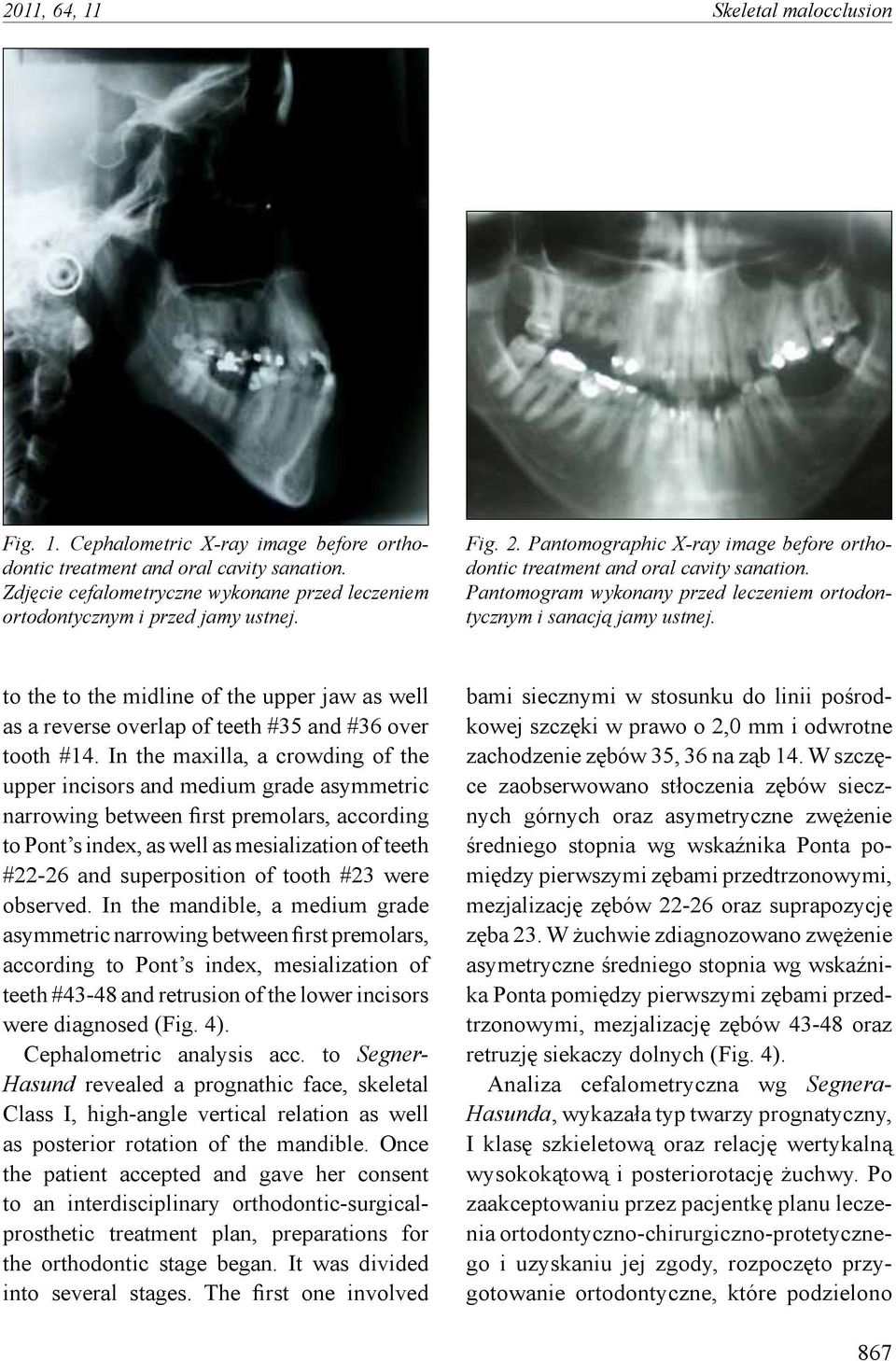 Pantomogram wykonany przed leczeniem ortodontycznym i sanacją jamy ustnej. to the to the midline of the upper jaw as well as a reverse overlap of teeth #35 and #36 over tooth #14.