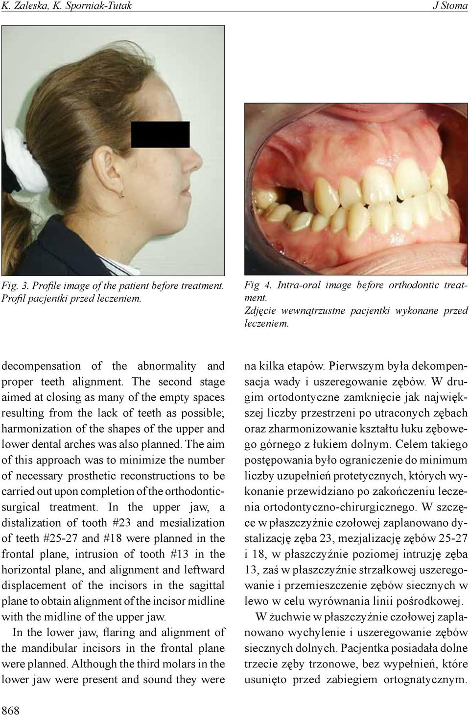 The second stage aimed at closing as many of the empty spaces resulting from the lack of teeth as possible; harmonization of the shapes of the upper and lower dental arches was also planned.