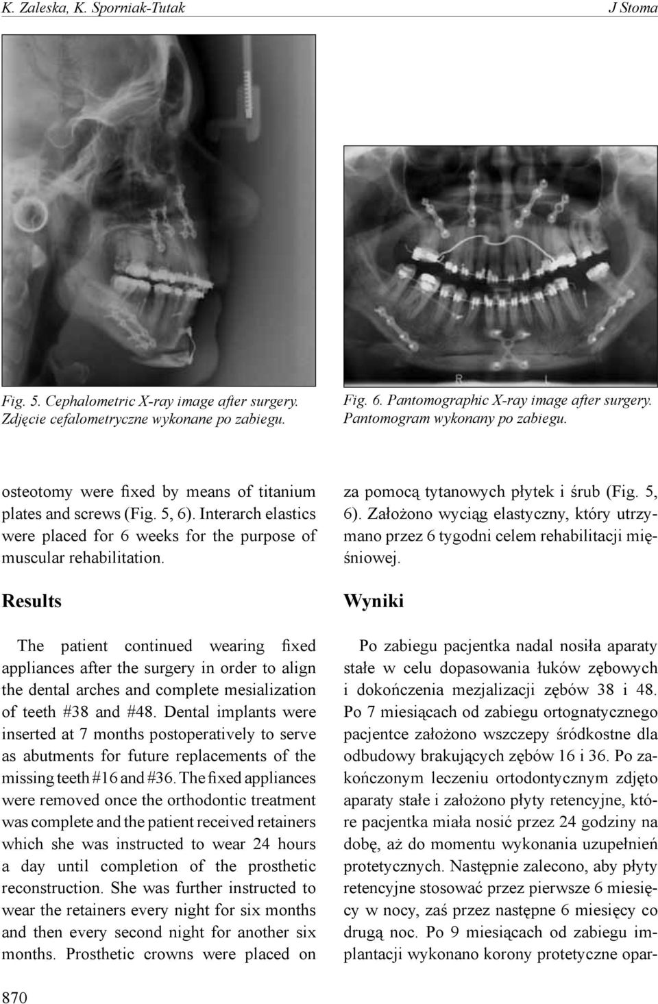 Results The patient continued wearing fixed appliances after the surgery in order to align the dental arches and complete mesialization of teeth #38 and #48.
