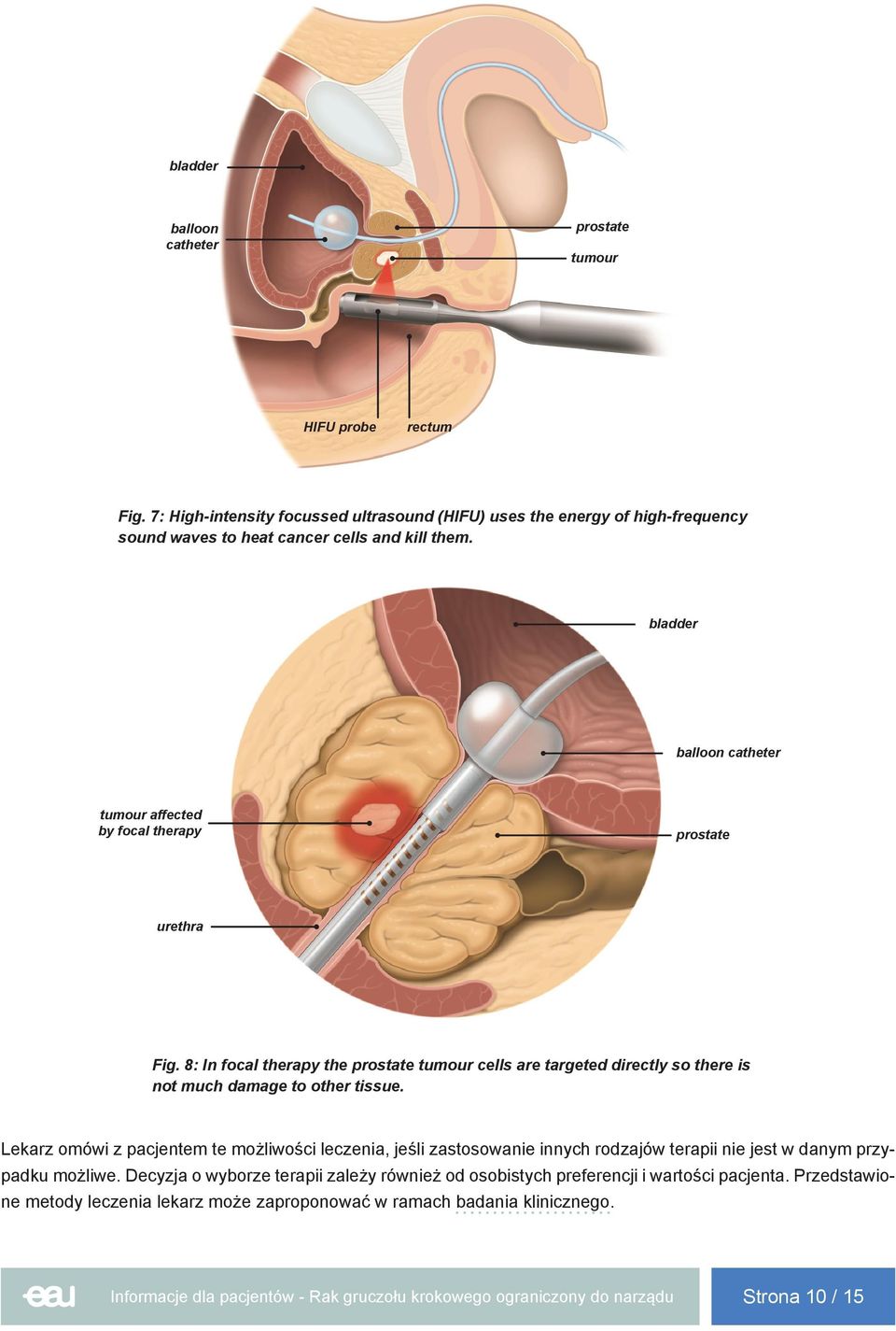 bladder balloon catheter tumour affected by focal therapy prostate urethra Fig.