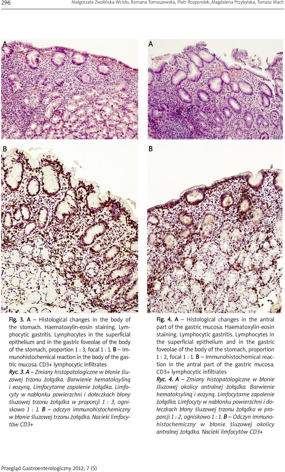 B Im - munohistochemical reaction in the body of the gastric mucosa. CD3+ lymphocytic infiltrates Ryc. 3. A Zmiany histopatologiczne w błonie śluzowej trzonu żołądka. Barwienie hematoksyliną i eozyną.