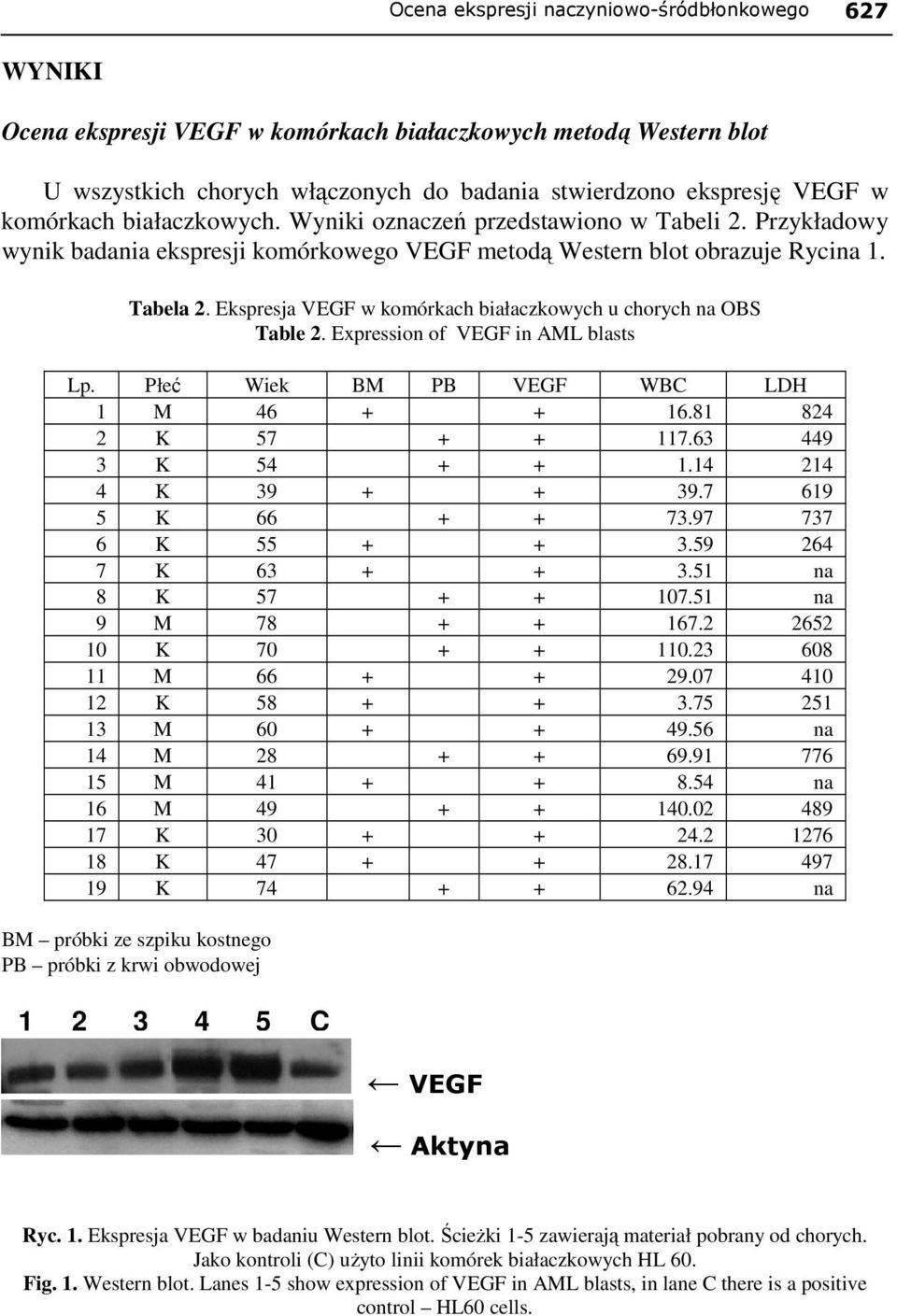 Ekspresja VEGF w komórkach białaczkowych u chorych na OBS Table 2. Expression of VEGF in AML blasts Lp. Płeć Wiek BM PB VEGF WBC LDH 1 M 46 + + 16.81 824 2 K 57 + + 117.63 449 3 K 54 + + 1.