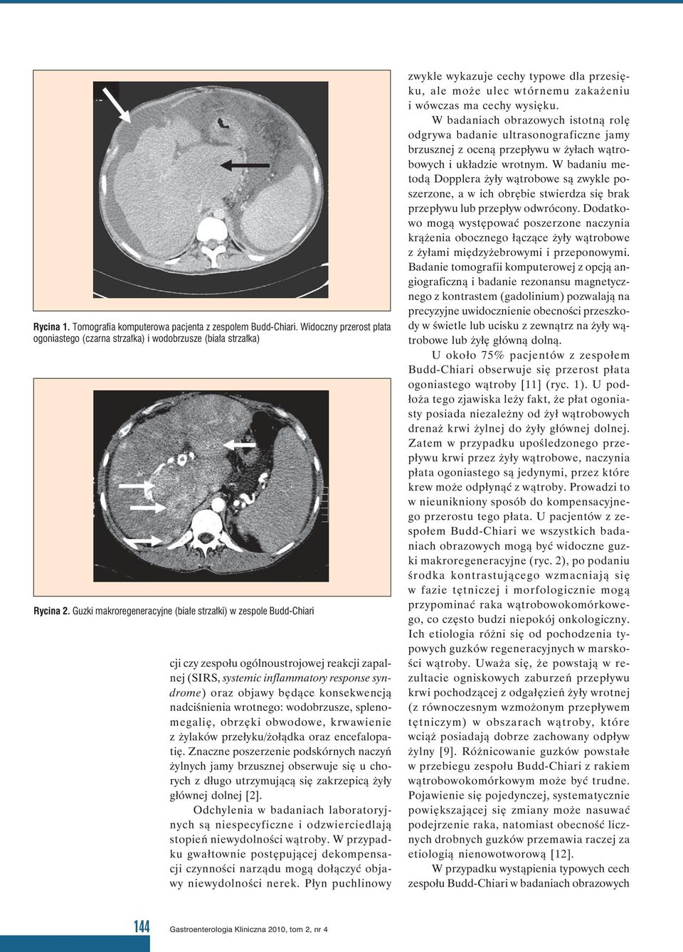 nadciśnienia wrotnego: wodobrzusze, splenomegalię, obrzęki obwodowe, krwawienie z żylaków przełyku/żołądka oraz encefalopatię.