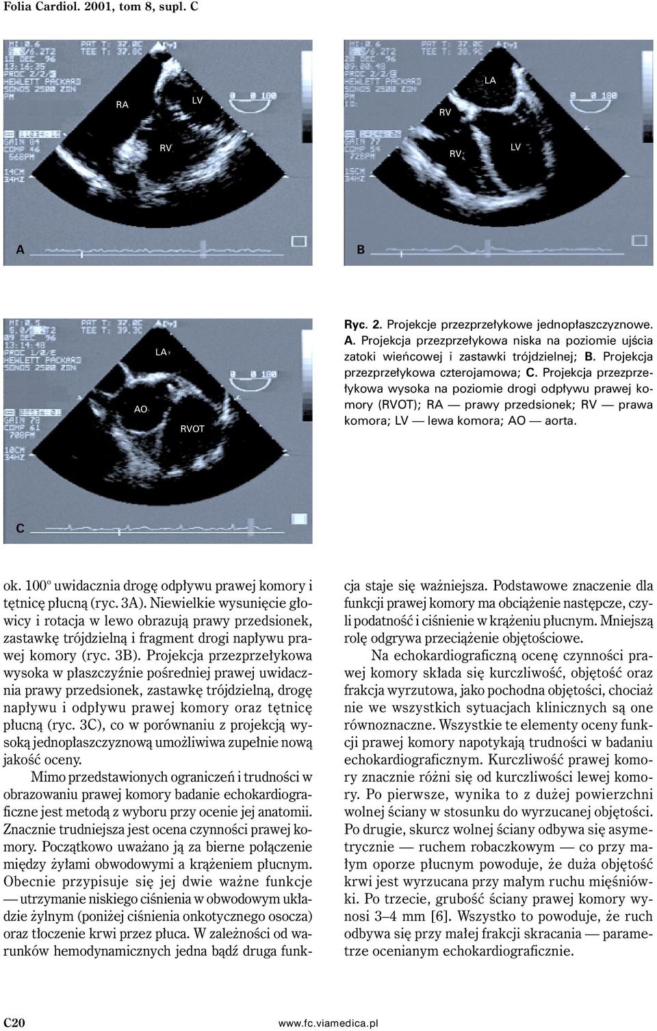 100 o uwidacznia drogę odpływu prawej komory i tętnicę płucną (ryc. 3A).