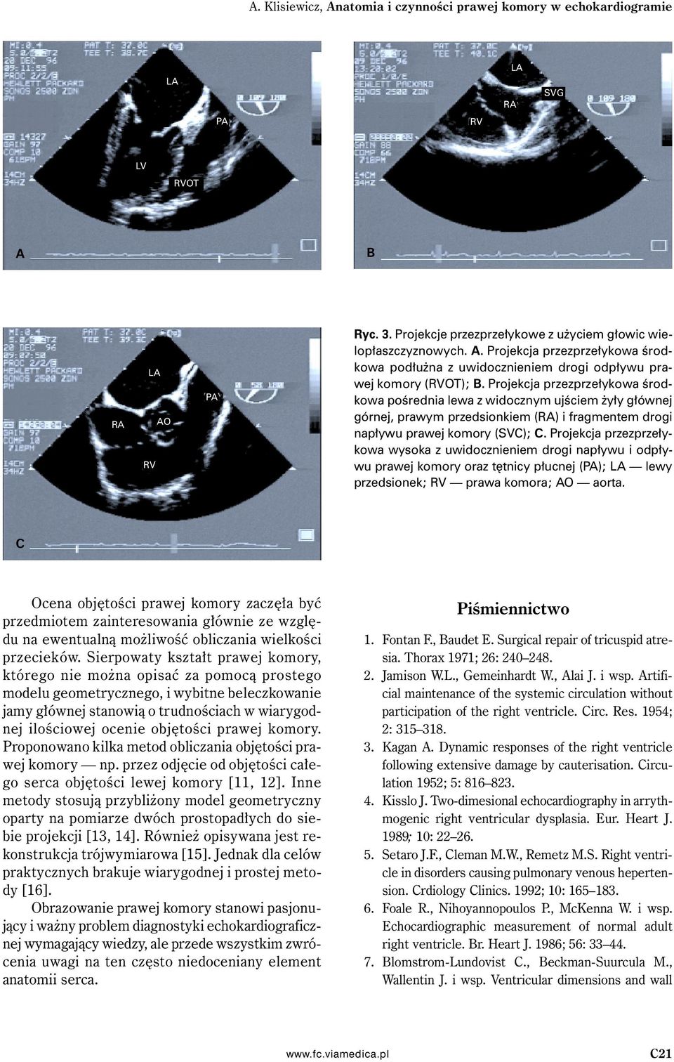 Projekcja przezprzełykowa wysoka z uwidocznieniem drogi napływu i odpływu prawej komory oraz tętnicy płucnej (); lewy przedsionek; prawa komora; aorta.