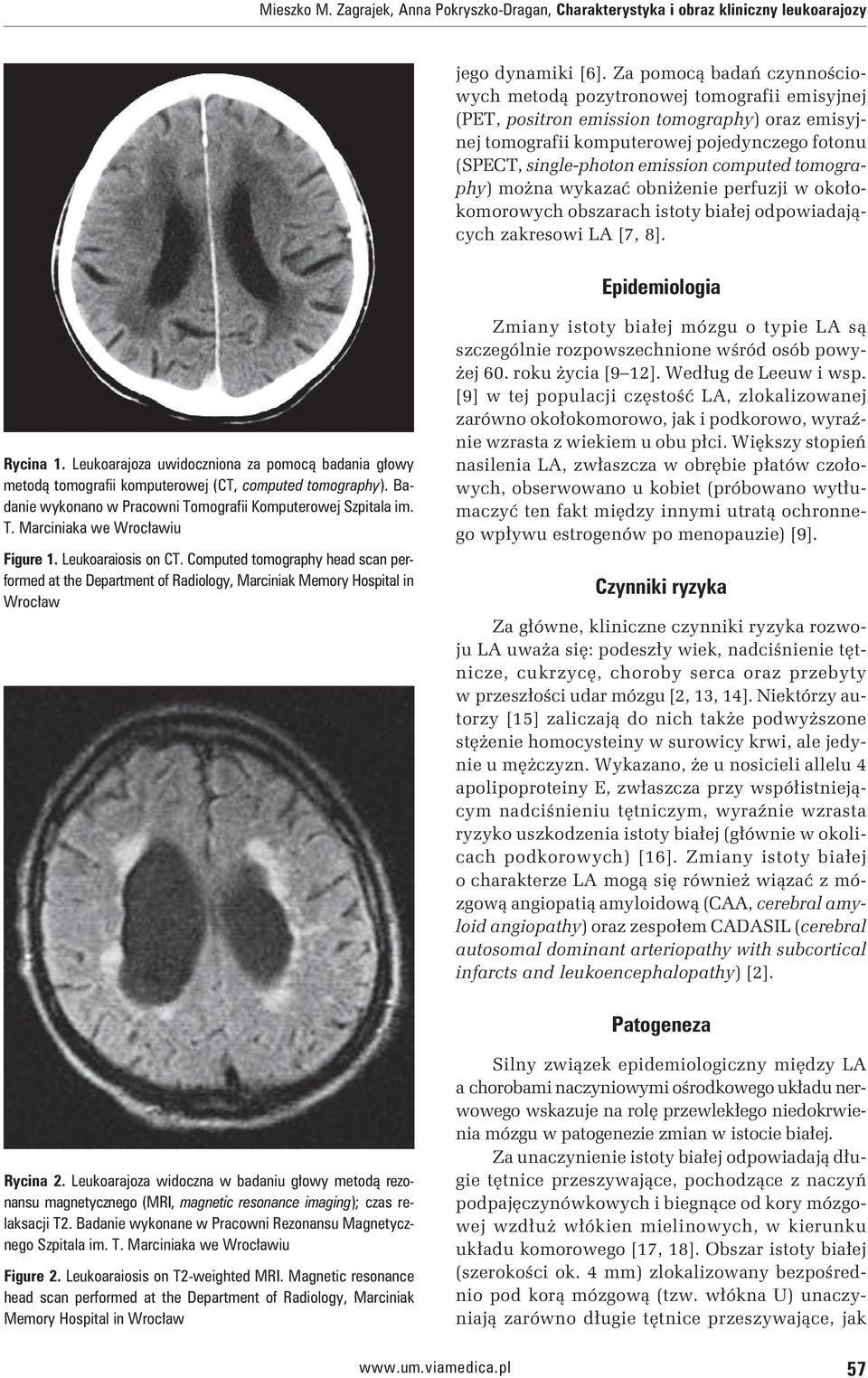 computed tomography) można wykazać obniżenie perfuzji w okołokomorowych obszarach istoty białej odpowiadających zakresowi LA [7, 8]. Epidemiologia Rycina 1.