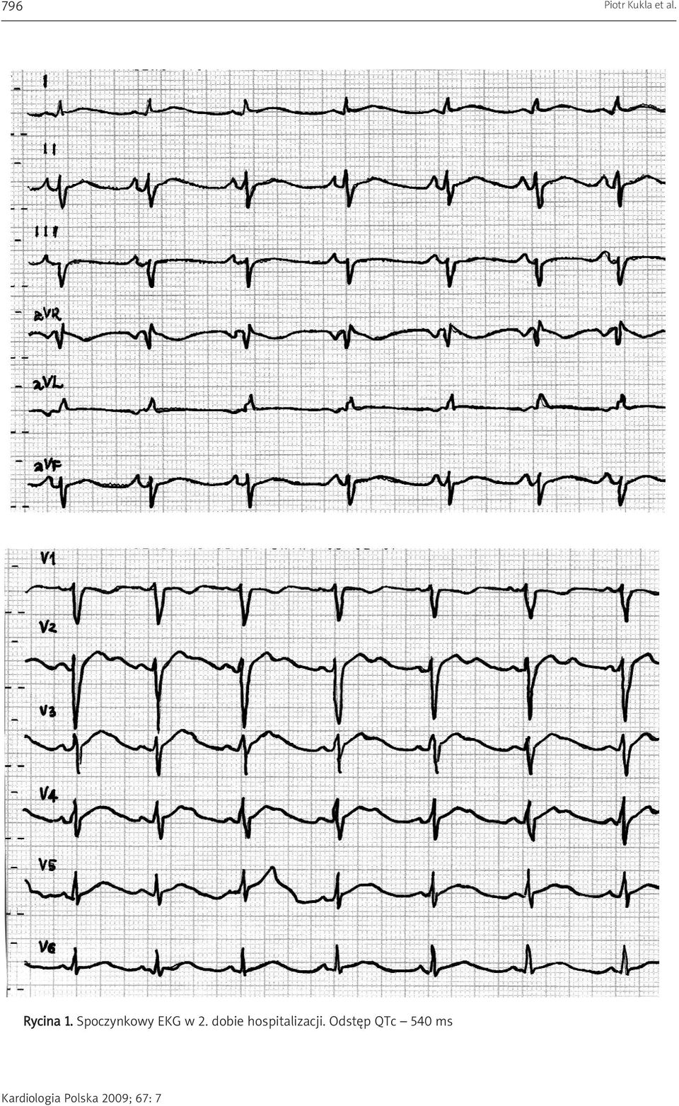 Spoczynkowy EKG w 2.
