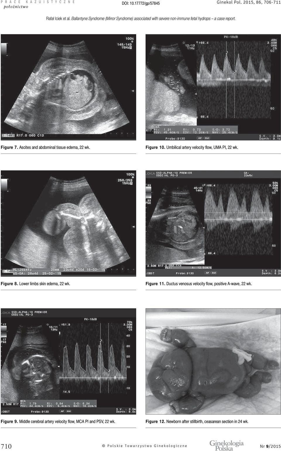 Lower limbs skin edema, 22 wk. Figure 11. Ductus venosus velocity flow, positive A-wave, 22 wk. Figure 9.