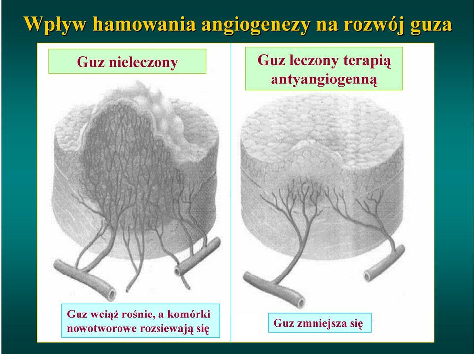 antyangiogenną Guz wciąż rośnie, a
