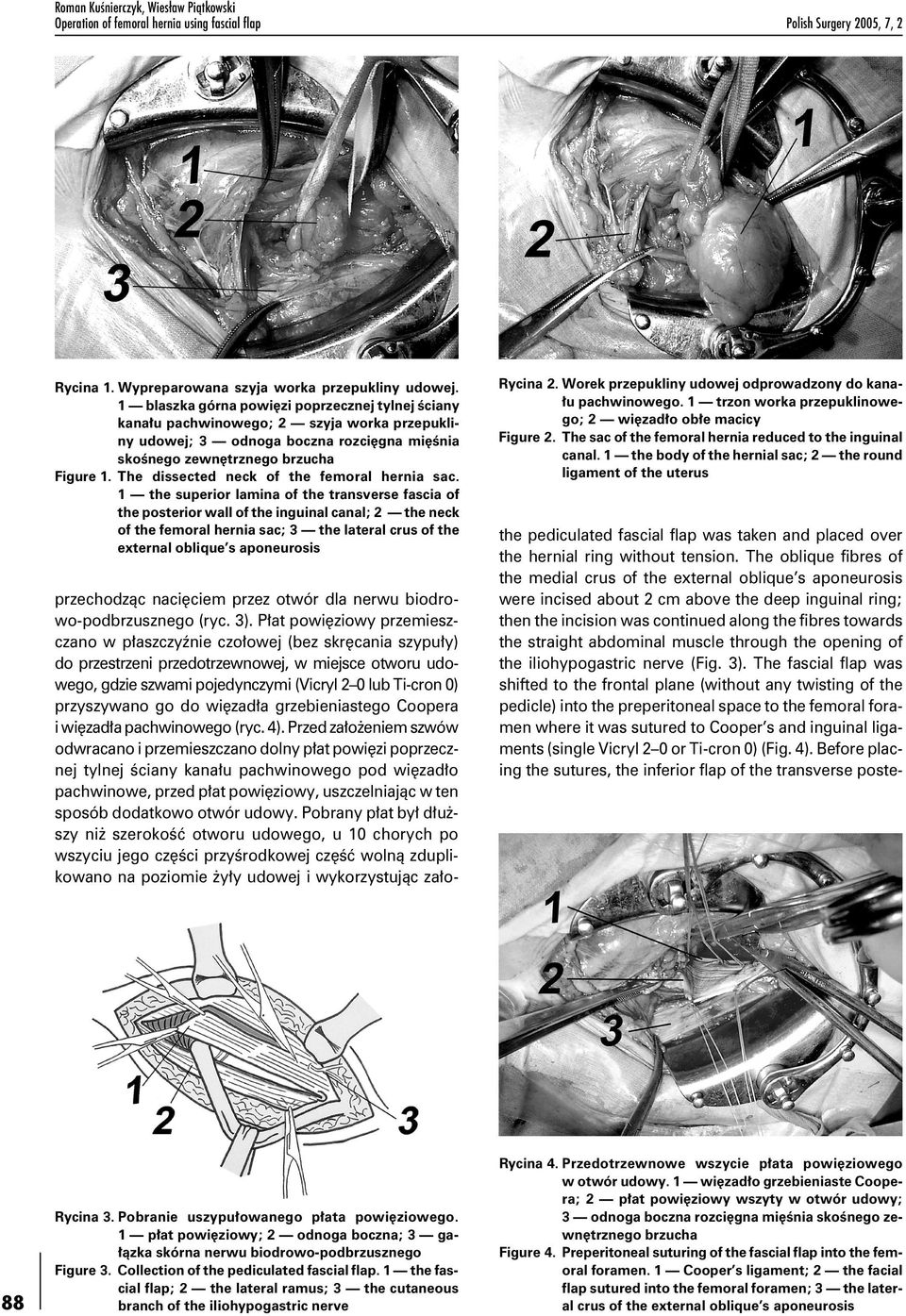 The dissected neck of the femoral hernia sac.