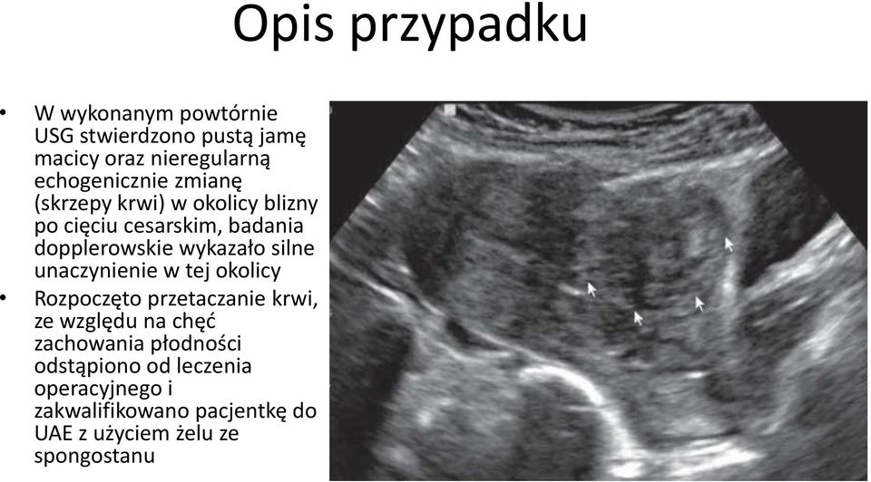 unaczynienie w tej okolicy Rozpoczęto przetaczanie krwi, ze względu na chęć zachowania płodności
