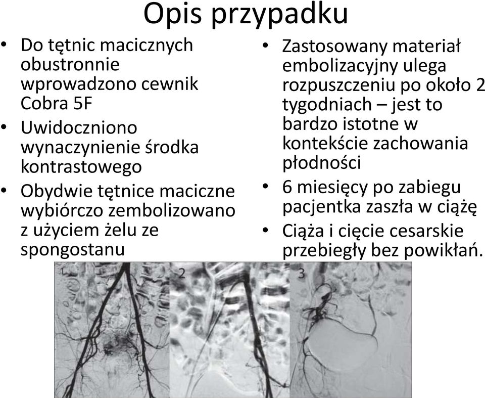 materiał embolizacyjny ulega rozpuszczeniu po około 2 tygodniach jest to bardzo istotne w kontekście