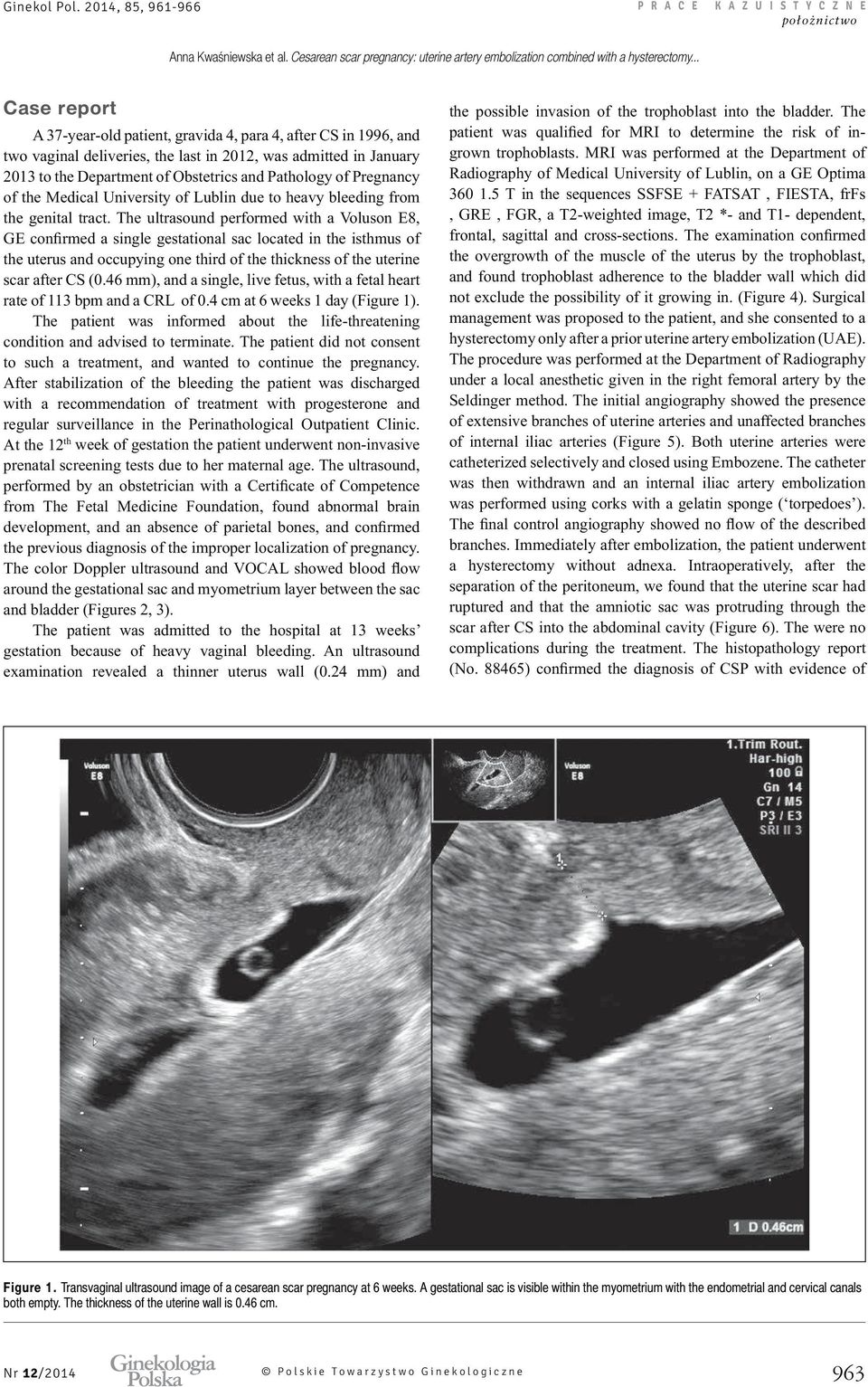The ultrasound, from The Fetal Medicine Foundation, found abnormal brain around the gestational sac and myometrium layer between the sac and found trophoblast adherence to the bladder wall which did