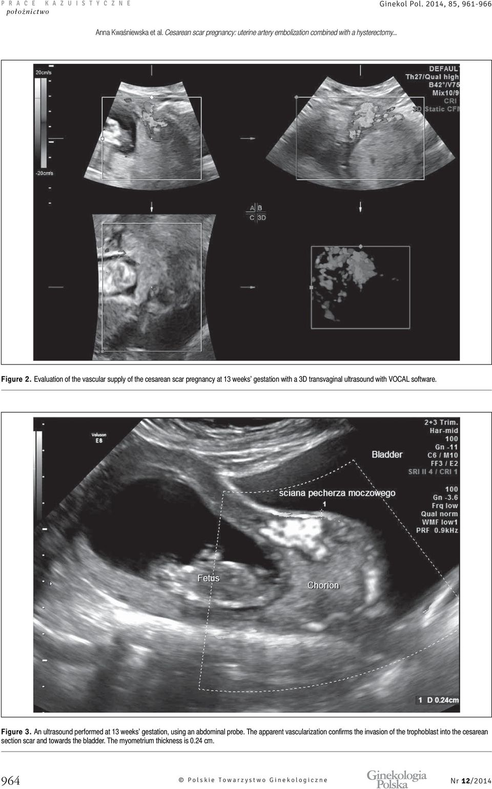 VOCAL software. Figure 3. An ultrasound performed at 13 weeks gestation, using an abdominal probe.
