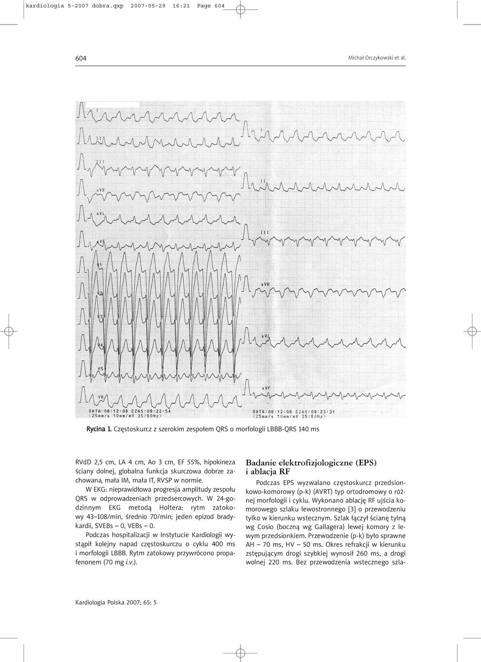 w normie. W EKG: nieprawidłowa progresja amplitudy zespołu QRS w odprowadzeniach przedsercowych.