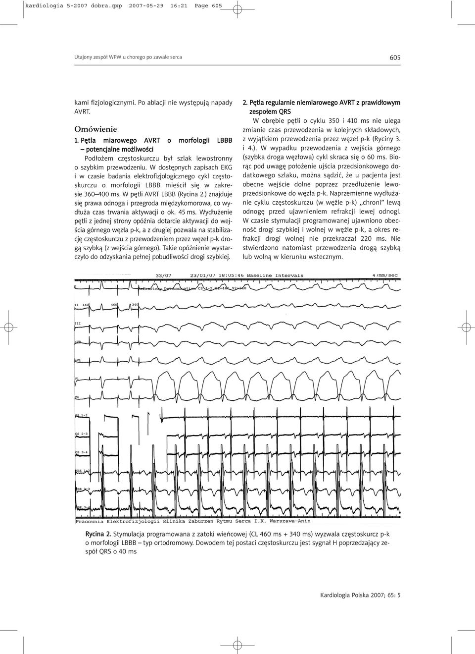 W dostępnych zapisach EKG i w czasie badania elektrofizjologicznego cykl częstoskurczu o morfologii LBBB mieścił się w zakresie 360 400 ms. W pętli AVRT LBBB (Rycina 2.