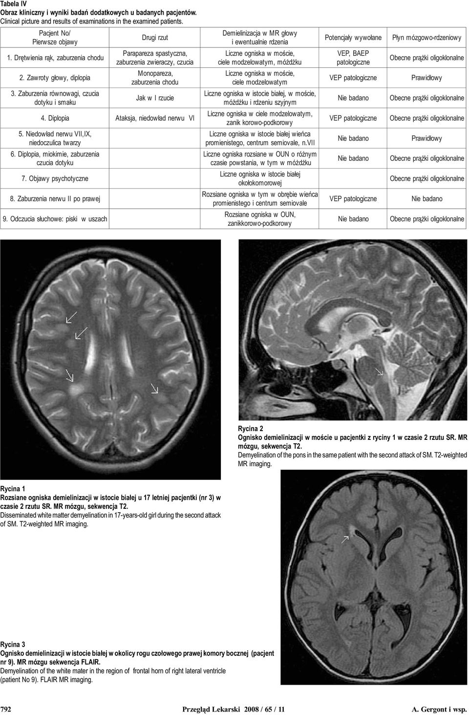 Zaburzenia równowagi, czucia dotyku i smaku Drugi rzut Parapareza spastyczna, zaburzenia zwieraczy, czucia Monopareza, zaburzenia chodu Jak w I rzucie 4. Diplopia Ataksja, niedow³ad nerwu VI 5.