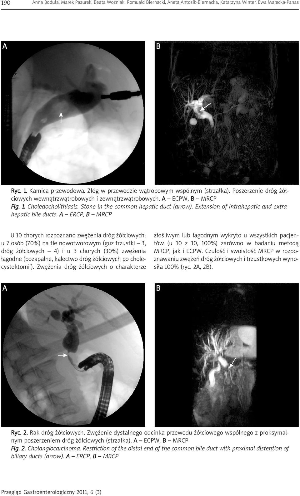 Stone in the common hepatic duct (arrow). Extension of intrahepatic and extrahepatic bile ducts.