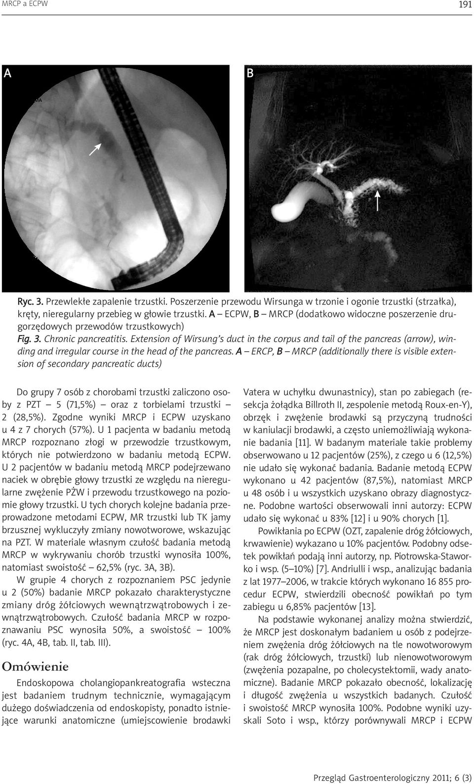 Extension of Wirsung s duct in the corpus and tail of the pancreas (arrow), winding and irregular course in the head of the pancreas.