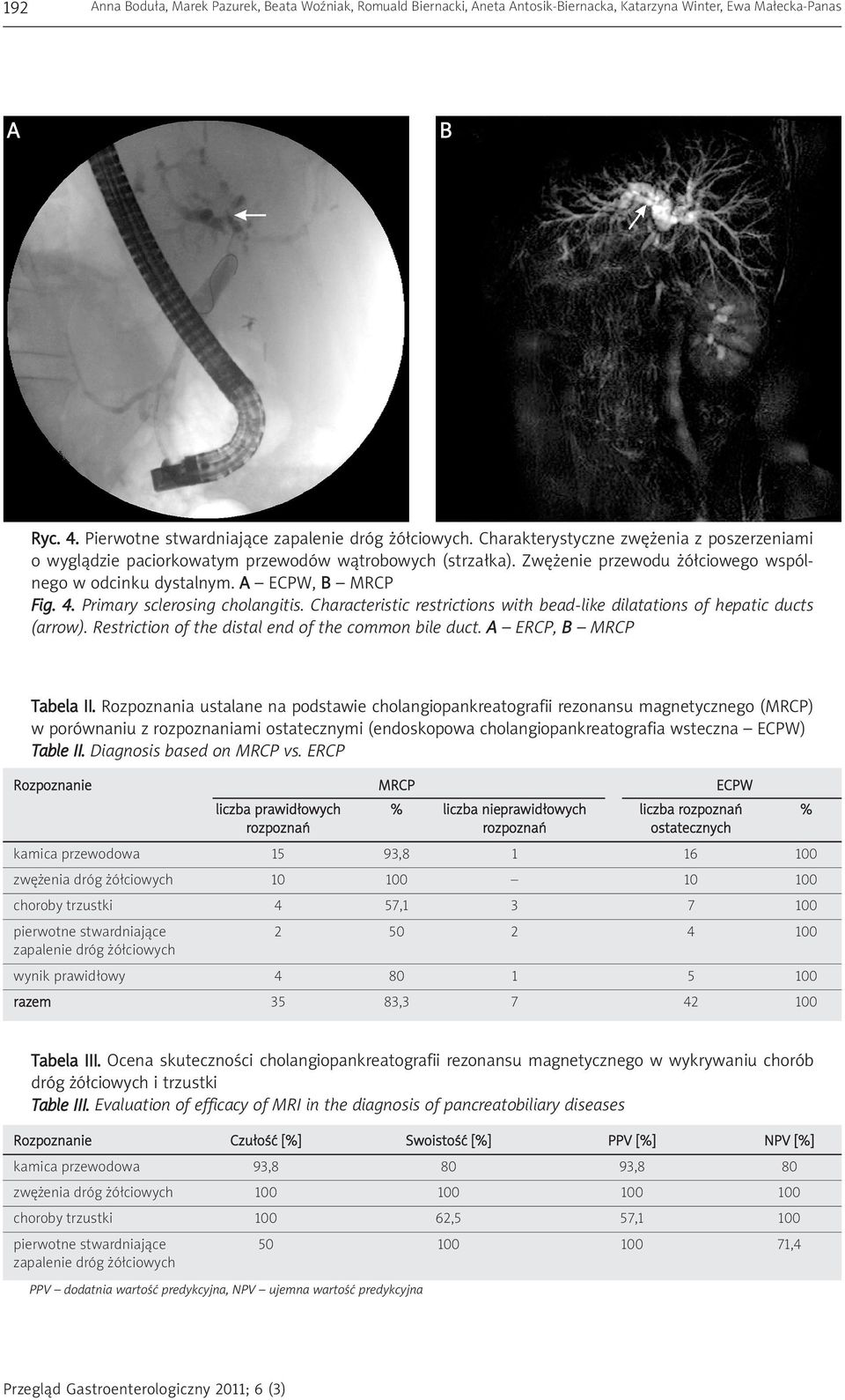 Primary sclerosing cholangitis. Characteristic restrictions with bead-like dilatations of hepatic ducts (arrow). Restriction of the distal end of the common bile duct. A ERCP, B MRCP Tabela II.