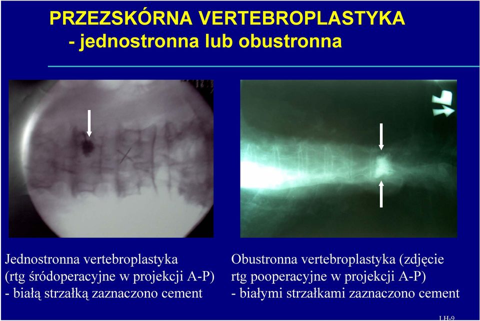 zaznaczono cement Obustronna vertebroplastyka (zdjęcie rtg