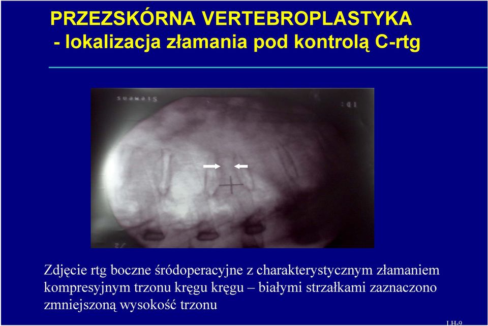 charakterystycznym złamaniem kompresyjnym trzonu