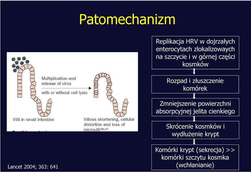 powierzchni absorpcyjnej jelita cienkiego Skrócenie kosmków i wydłużenie krypt