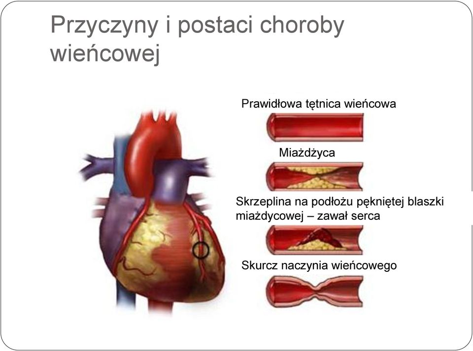 Skrzeplina na podłożu pękniętej blaszki