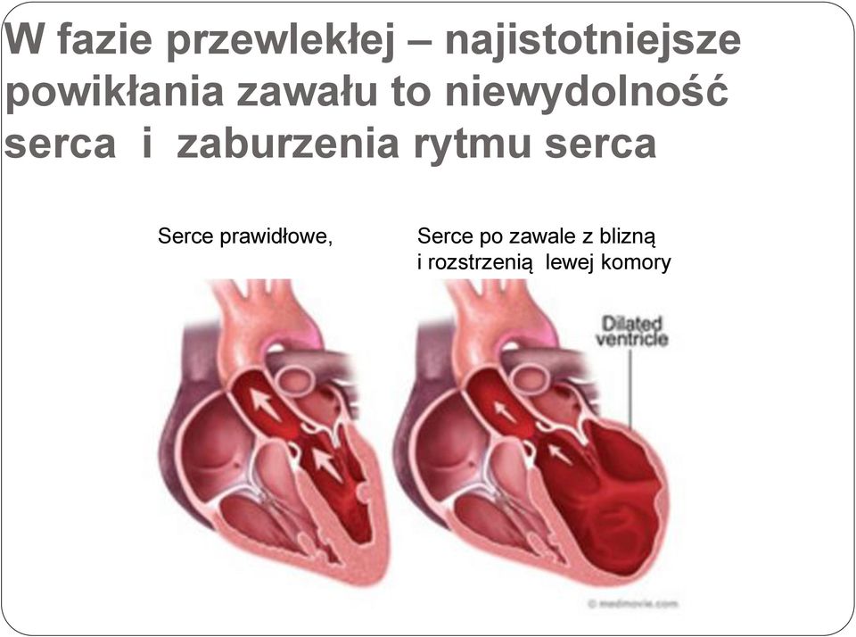 zaburzenia rytmu serca Serce prawidłowe,